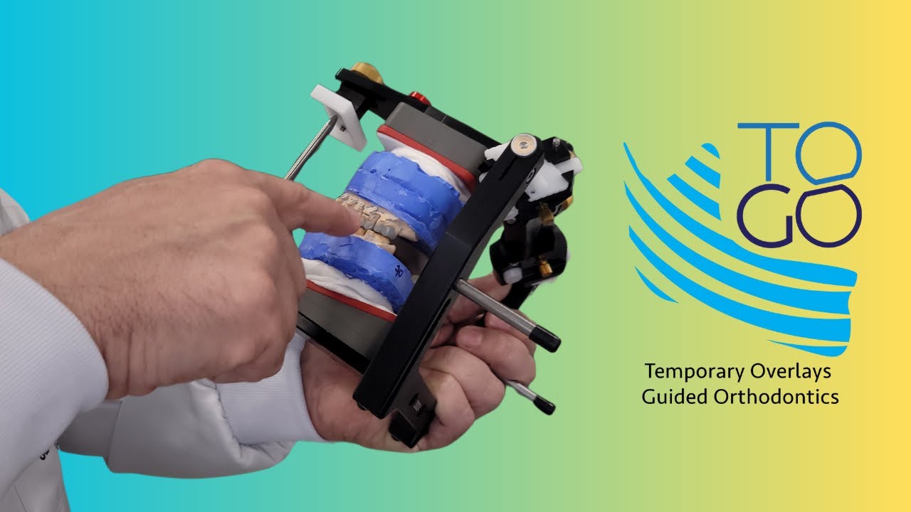 Ortodontia Guiada por Overlays Temporários (TOGO)